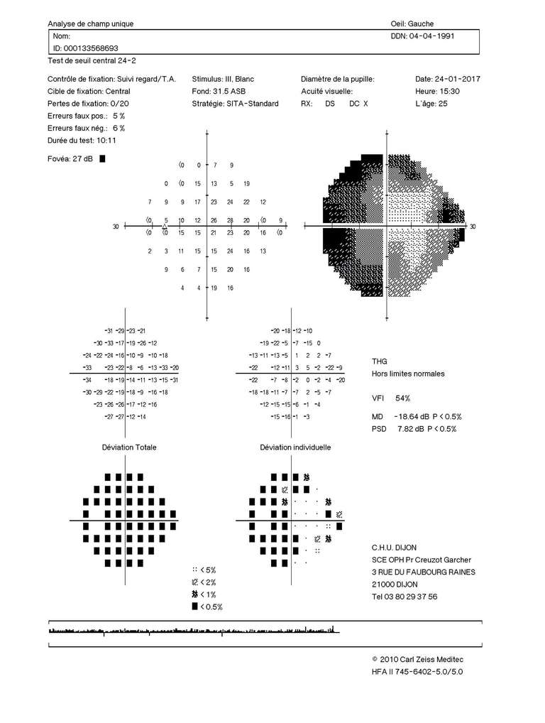 Figure 4. Champ visuel automatisé Humphrey 24.2 de l’œil gauche : champ visuel tubulaire.
