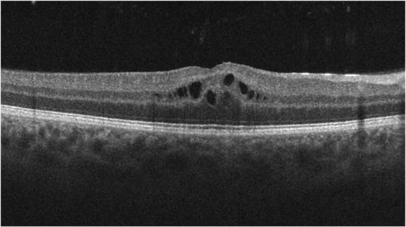 Figure 1. SD-OCT de l’œil droit d’un patient présentant un œdème maculaire cystoïde.
