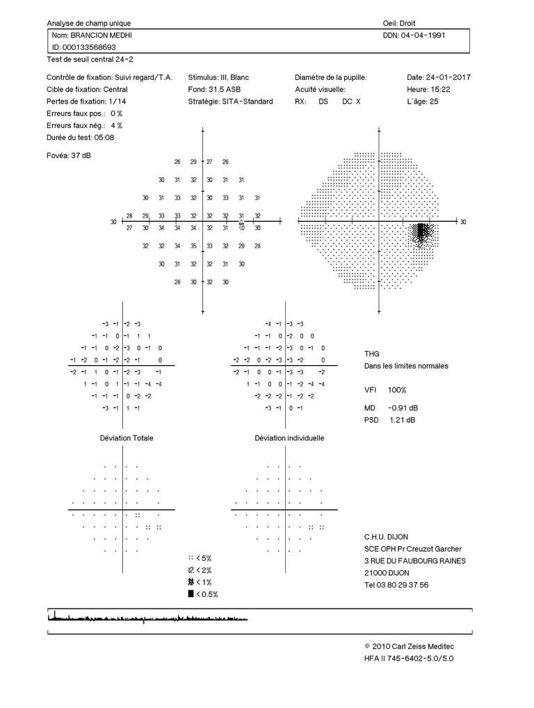 Figure 5. Champ visuel automatisé Humphrey 24.2 de l’œil droit : pas de déficit campimétrique.
