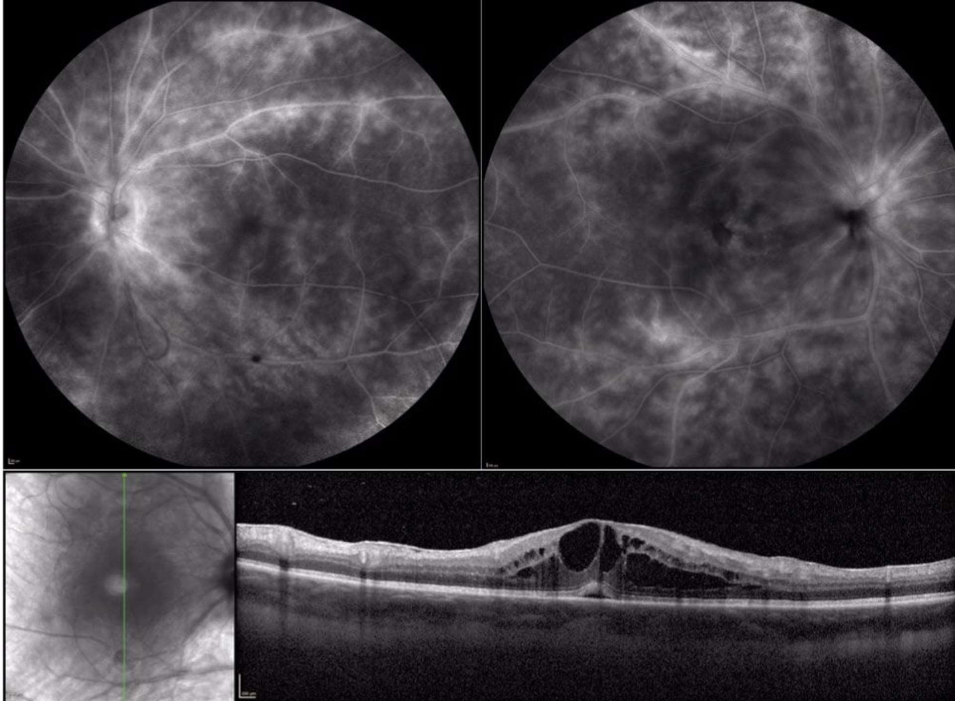 Figure 2. Angiographie rétinienne à la fluorescéine et tomographie rétinienne en cohérence optique : vasculite bilatérale diffuse compliquée d’un œdème maculaire cystoïde.
