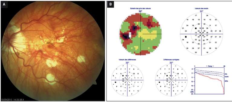 Figure 3. Rétinophotos (A) et champ visuel (B) de l’œil gauche d’un patient myope fort sans atteinte glaucomateuse. Le CV retrouve des déficits localisés pouvant conduire à un faux diagnostic de glaucome. La corrélation avec le fond d’œil confirme que tous les déficits sont en rapport avec une atrophie rétinienne et que le nerf optique présente un anneau neurorétinien épais.
