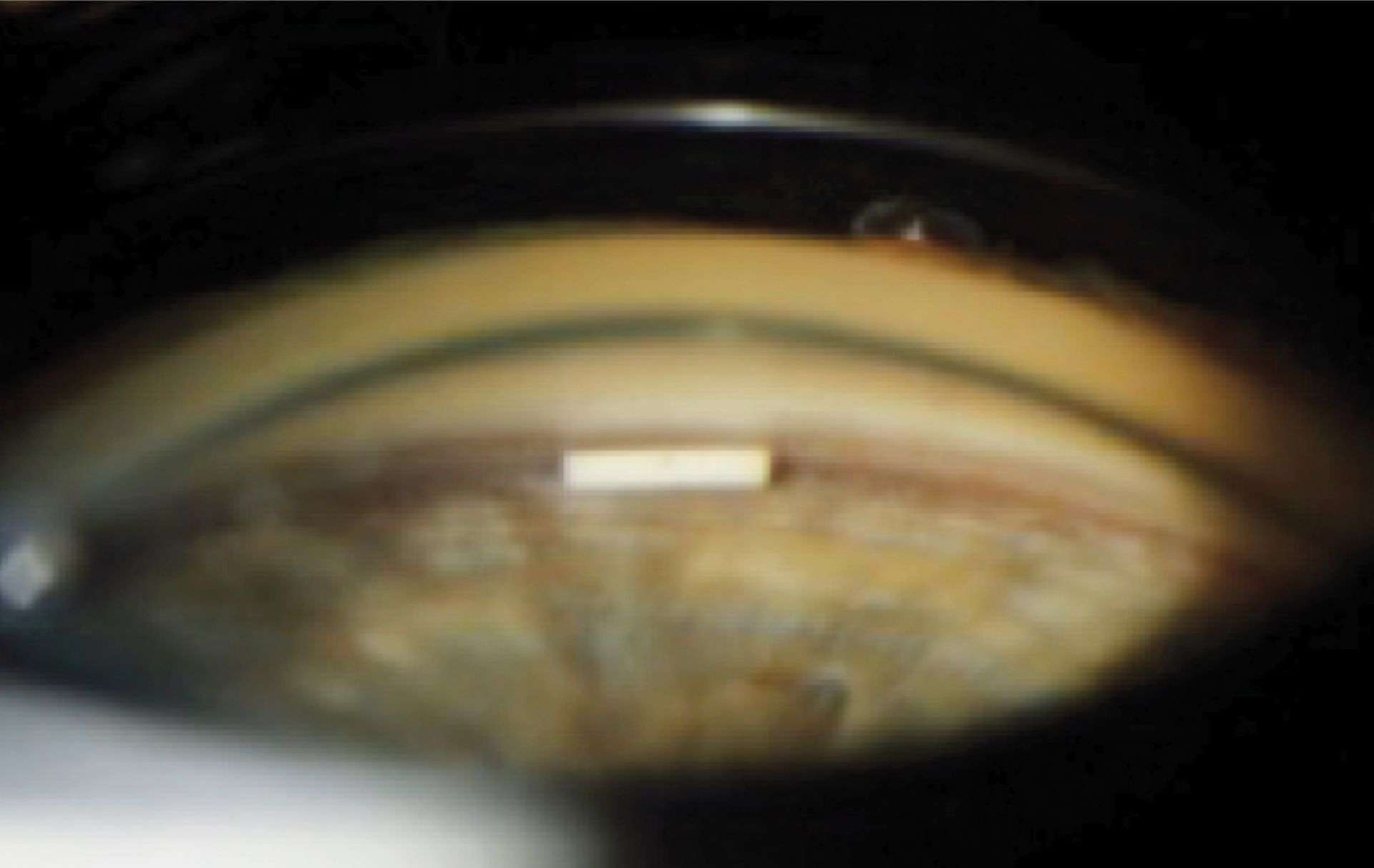 Figure 5. Implant de bimatoprost intracamérulaire situé dans ­l’angle iridocornéen 2 semaines après l’injection.

