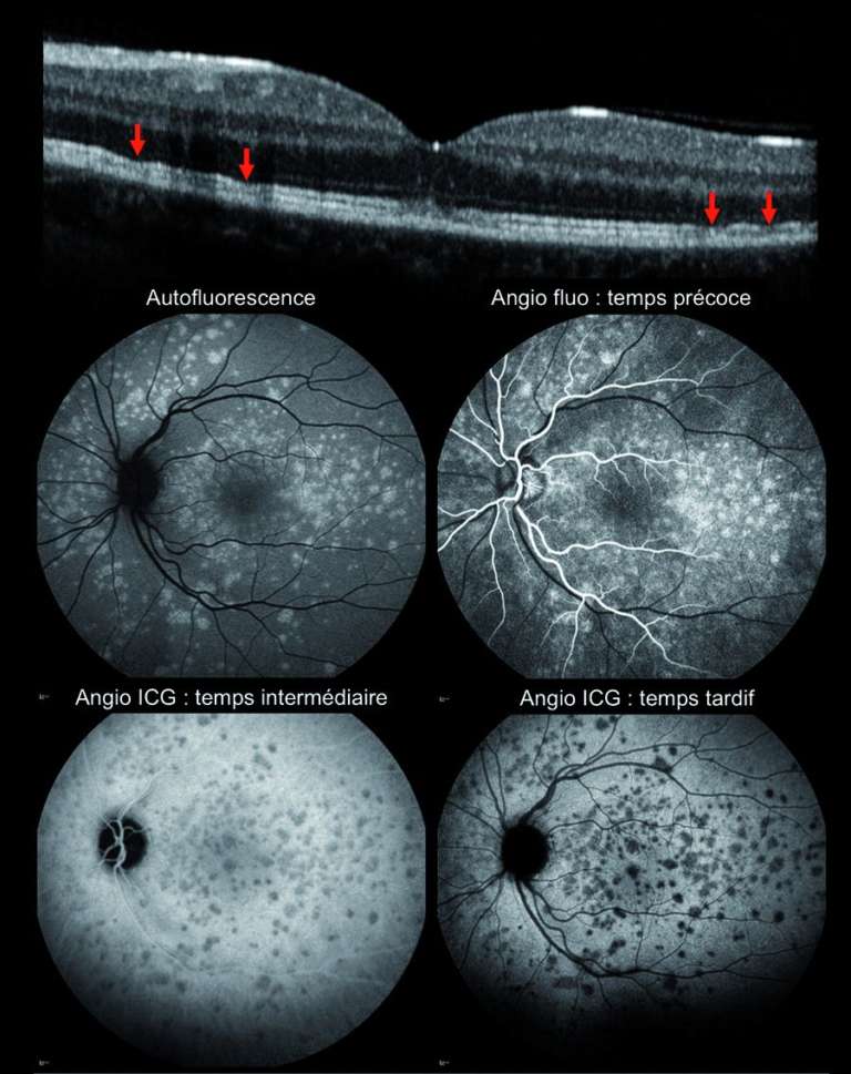 Figure 1. Syndrome des taches blanches évanescentes de l’œil gauche. L’OCT montre une irrégularité de la zone ellipsoïde (flèches). Les lésions sont hyper-autofluorescentes et bien visibles dès les temps précoces de l’angiographie à la fluorescéine. En angiographie au vert d’indocyanine, elles apparaissent au temps intermédiaire et sont très visibles au temps tardif.
