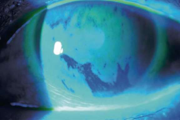 Instabilité du film lacrymal post-chirurgie de la cataracte.
