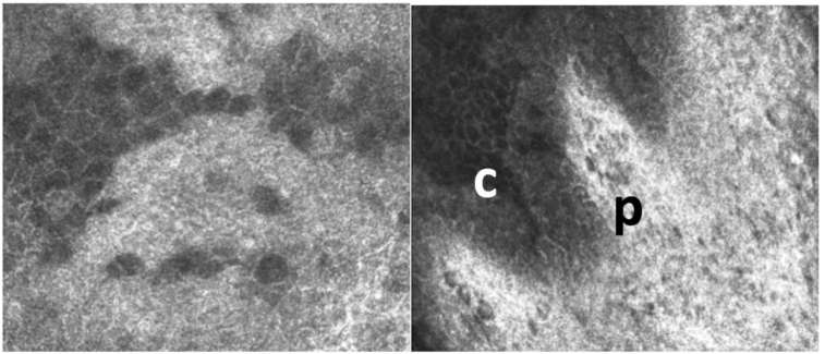 Figure 2. Microscopie confocale in vivo d’un limbe normal.&nbsp;Présence de populations cellulaires distinctes. Alternance de palissades de Vogt hyperréflectives (p) et cryptes limbiques (c).
