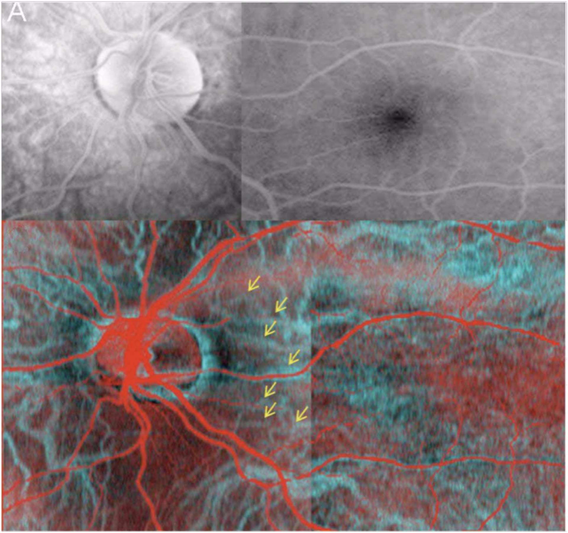 Clichés de la région papillaire et de la macula, en angiographie à la fluoroscéine (a) et en Optical Coherence Angiography
