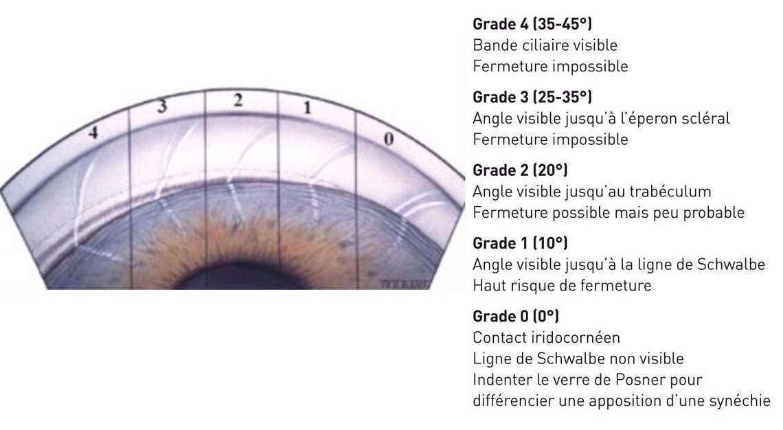 Figure 1. Classification de Schaffer du degré d’ouverture de l’angle iridocornéen. Imagerie du segment antérieur : OCT de segment antérieur et ultrabiomicroscopie (UBM) ; ces techniques ont l’avantage d’être fiables et reproductibles et permettent d’apprécier l’angle, la profondeur de chambre antérieur et la flèche cristallinienne. L’UBM offre l’avantage d’une visibilité de la chambre postérieure, en particulier le corps ciliaire, ainsi que d’une dilatation en ambiance scotopique, permettant de mettre en évidence les appositions iridotrabéculaires. Cependant, ces techniques ne peuvent remplacer la gonioscopie avec indentation car elles ne permettent pas de différencier les appositions des SAP.
