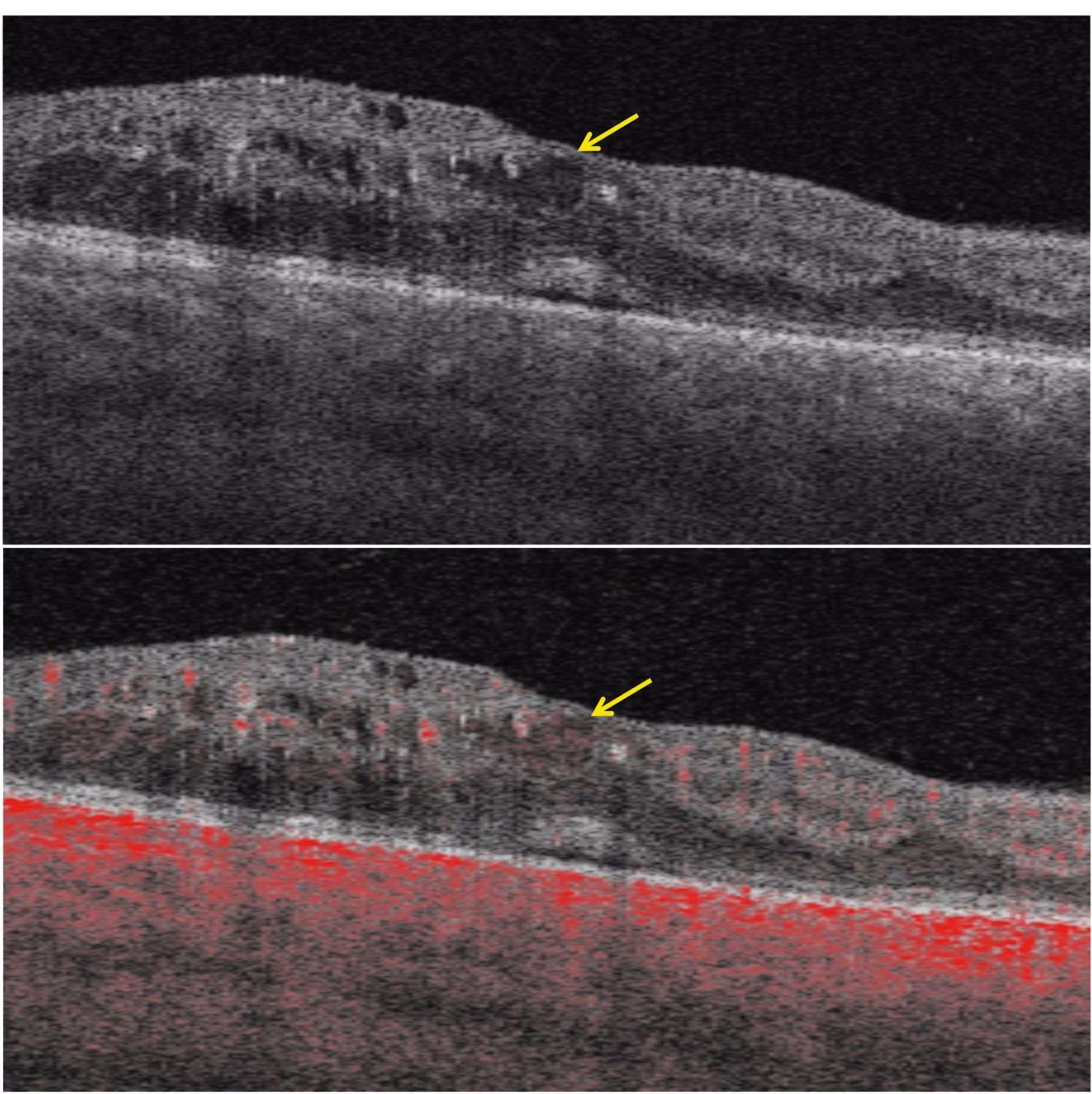 Figure 4. Coupes B-scan d’un OM chez une patiente diabétique. En haut. L’image structurelle montre la présence de kystes intrarétiniens. En bas. La même coupe en OCT-A qui montre la présence de SSPiM dans une des cavités (flèche jaune). 
