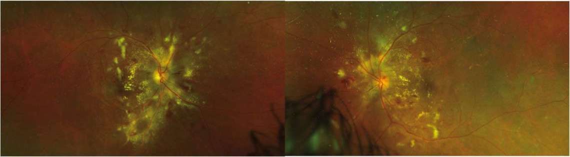 Figure 1. Photographie grand champ (Optos) du fond d’œil retrouvant un œdème papillaire, des hémorragies multiples, des exsudats secs et des nodules cotonneux.&nbsp;

