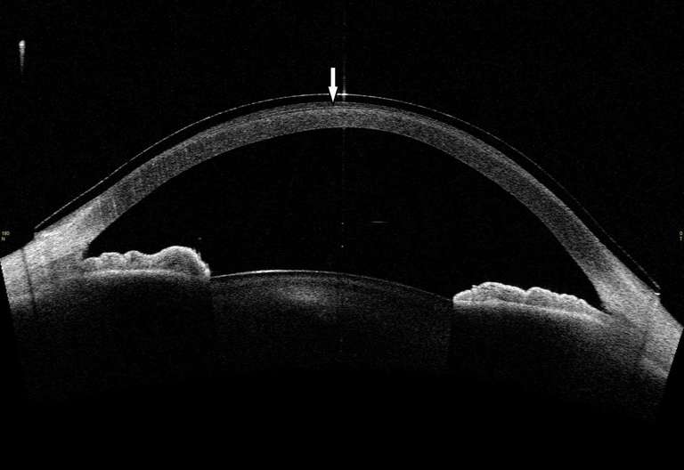 Figure 5. Image en OCT grand champ (Casia) de la lentille ­cornéo­sclérale Rose K2 XL avec une coupe horizontale 0°/180°. Il permet la visualisation de l’espace liquidien sous la lentille (↓) et l’alignement de la lentille avec le limbe et la sclère.
