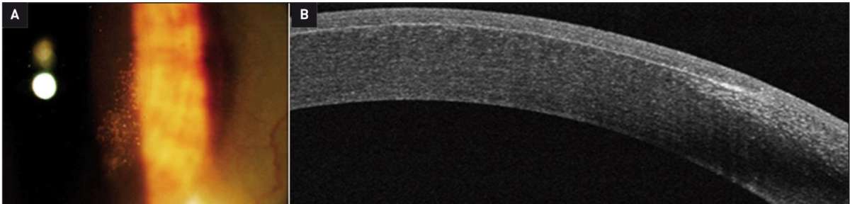 Figure 4. Photo de l’œil droit (A) montrant les dépôts dans l’interface et OCT correspondant (B) à 1 mois post-Lasik.
