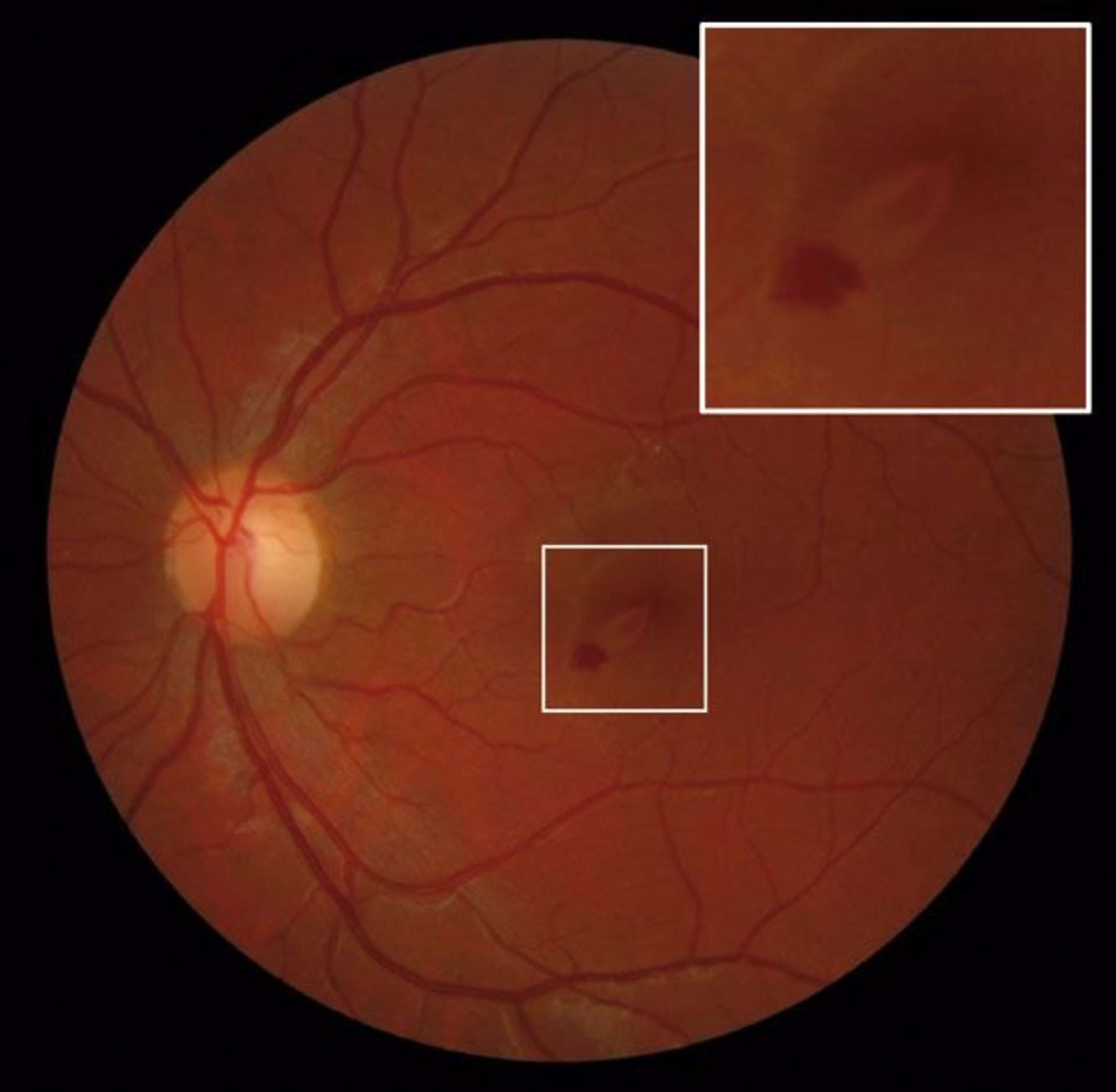 Figure 1. Rétinophotographie initiale de l’œil gauche montrant une lésion jauneorangé arrondie périfovéolaire inférieure et une hémorragie prérétinienne périlésionnelle
