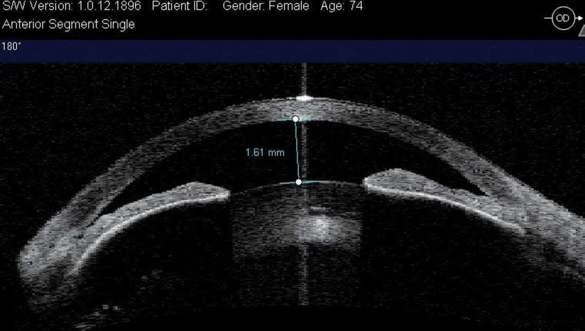Figure 1. Fermeture primitive de l’angle irido-cornéen : apposition irido-trabéculaire et bloc pupillaire liés à l’augmentation physiologique du volume cristallinien chez une femme de 74 ans (OCT de segment antérieur).
