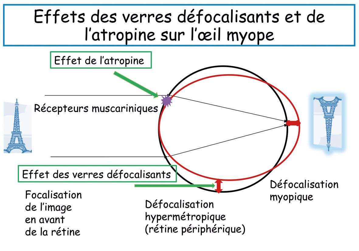 Figure 1. Effets des verres correcteurs défocalisants système DIMS et de l’atropine (en rouge l’œil myope). ©D. Brémond-Gignac
