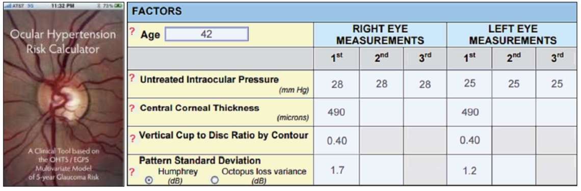 Figure 1. Exemple de calcul du risque de développer un glaucome à 5 ans avec le calculateur (ici 23,1% dans au moins 1 des 2 yeux).
