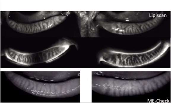 Figure 1. Comparaison des images meibographiques pour une même patiente de 52 ans. Noter la meilleure définition des images en infrarouge du LipiScan par rapport au ME-Check (aspect laiteux des glandes). Le LipiScan fournit aussi des images en transillumation (glandes vues en noir).
