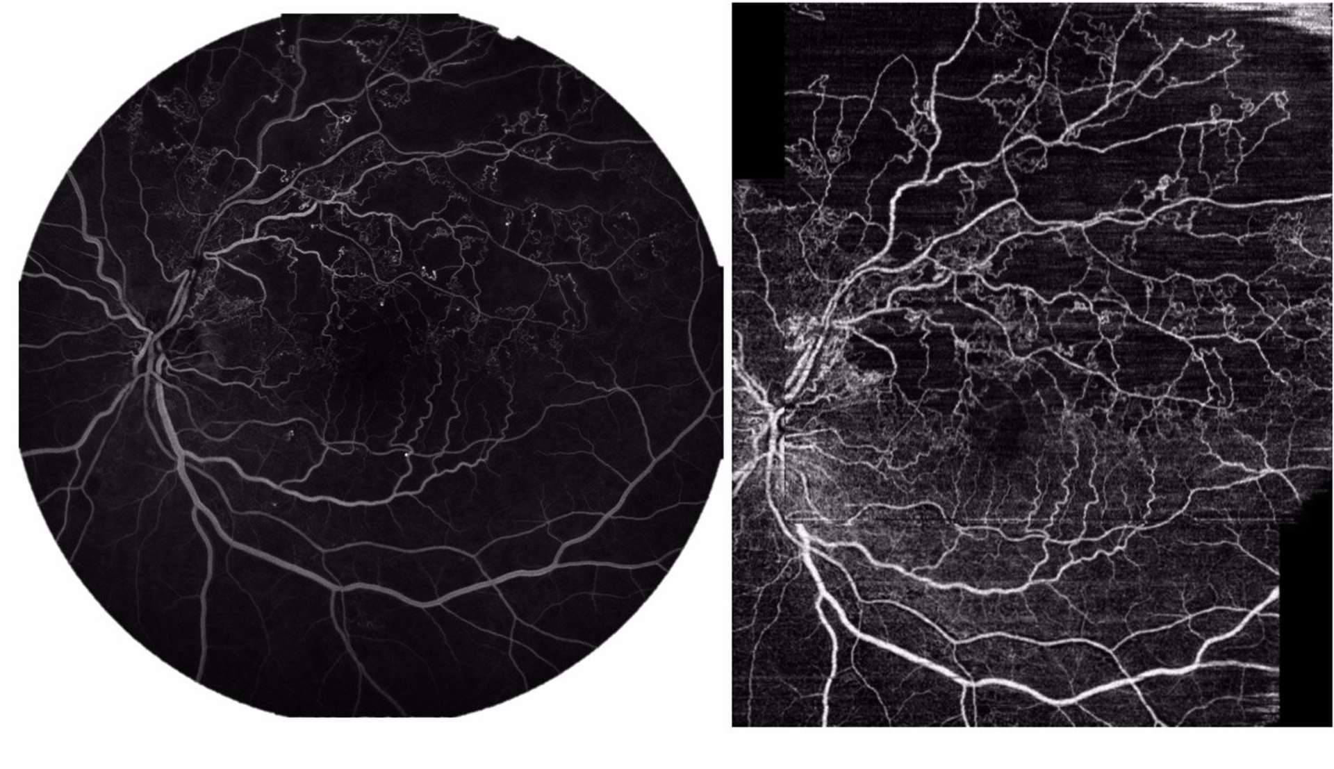 Figure 4. Comparaison entre une image d’angiographie à la fluorescéine à gauche réalisée sur un champ de 55° à l’aide du Spectralis HRA-OCT2 d’Heidelberg et d’une mosaïque grand champ de 2 images d’OCT-A de 12 x 12 mm obtenues grâce au DRI TritonTM de Topcon à droite. Les zones de non-perfusion en lien avec l’occlusion veineuse sont superposables sur les 2 modalités d’imagerie.
