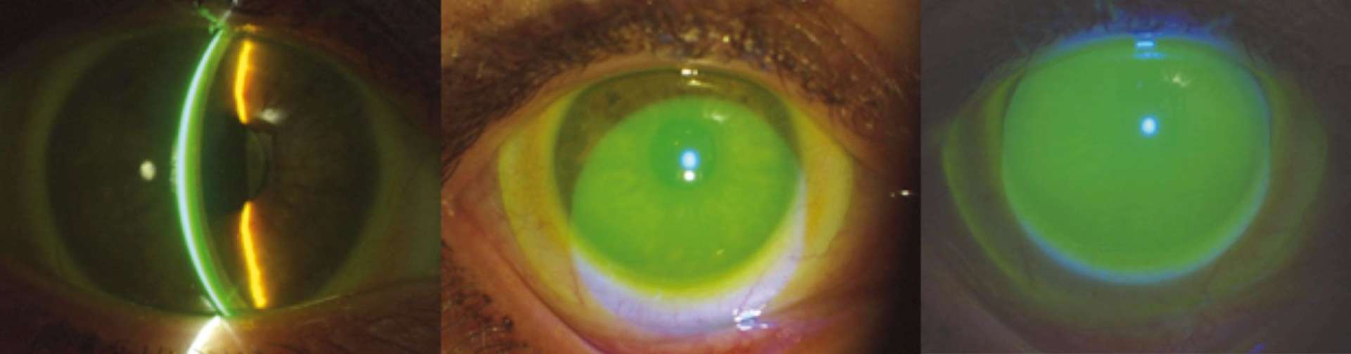 Figure 3. Observation d’une lentille sclérale avec ajout de fluo au sérum physiologique, lors de la pose.
