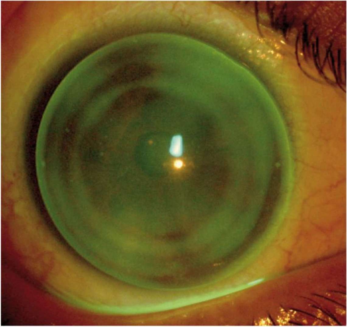 Figure 1. DRL pour compensation de l’astigmatisme, ici 4,5 D.
