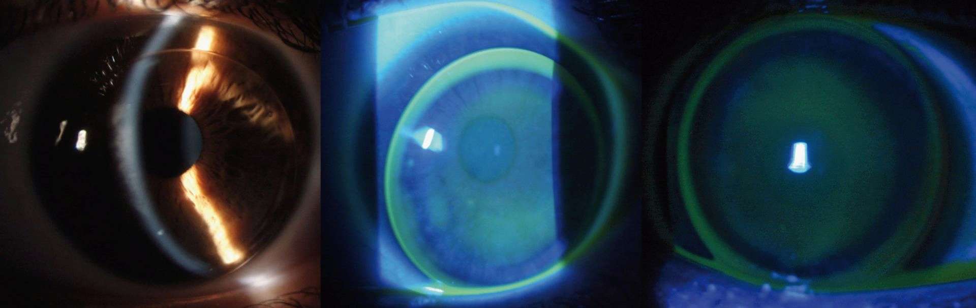 Figure 4. Photographies en lampe à fente. Lentille rigide sphérique posée sur l’œil gauche. Lentille centrée, fluorescéine homogène, sans appui central, bords suffisamment ouverts.  
