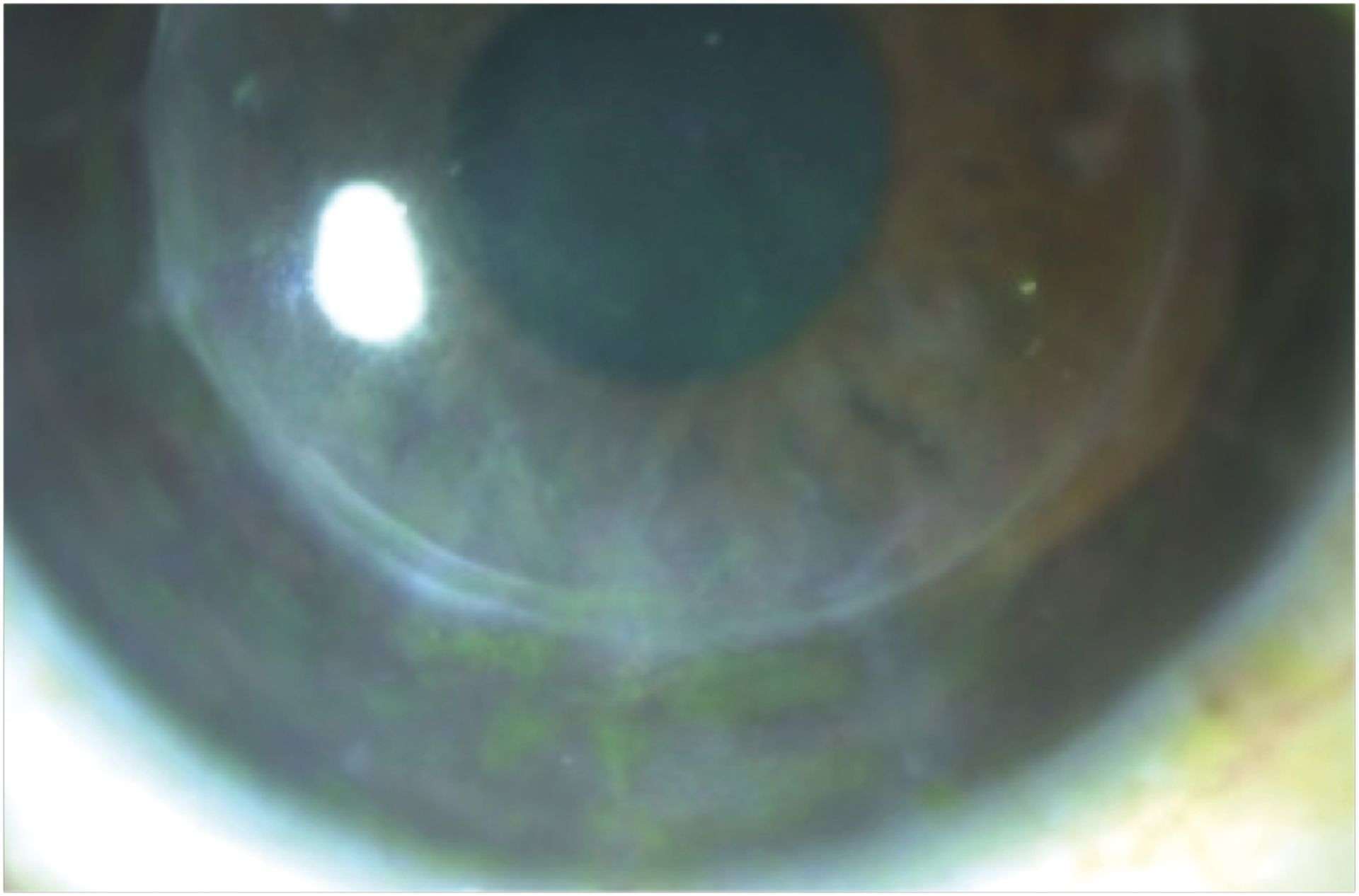 Figure 3A. Photographie de l’œil gauche à 4 jours du début du traitement par foscavir intraveineux.
