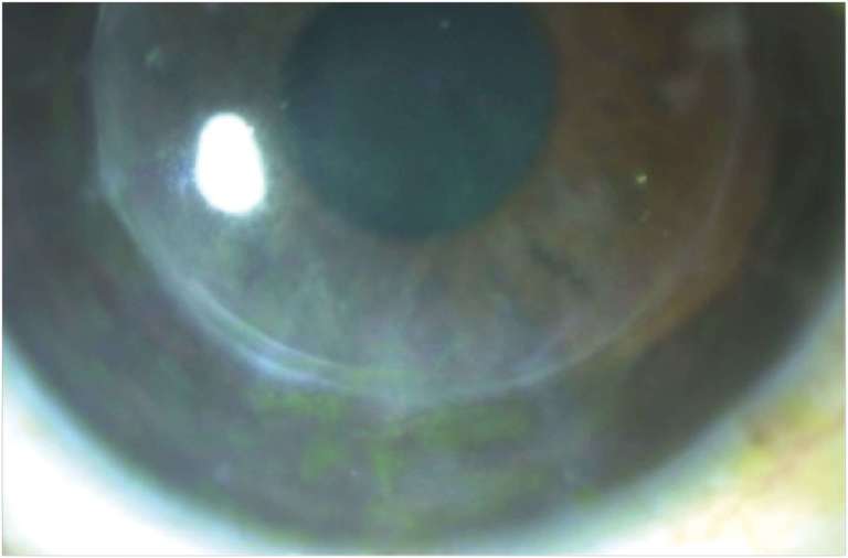 Figure 3A.&nbsp;Photographie de l’œil gauche à 4 jours du début du traitement par foscavir intraveineux.
