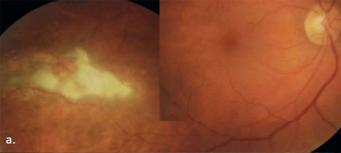 La rétinographie couleur montre un foyer choriorétinien blanc crémeux en temporal inférieur de la macula.

