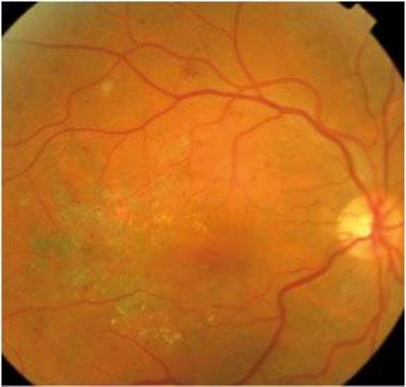 Figure 1. Rétinophoto de l’œil droit. On note la présence d’un œdème maculaire avec des hémorragies rétiniennes dans le cadre d’une rétinopathie diabétique modérée.

