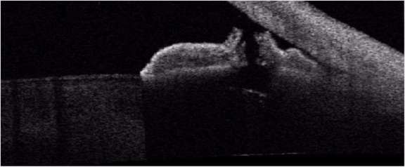 Figure 5. Coupes du segment antérieur d’un patient présentant un glaucome chronique par fermeture de l’angle après une iridotomie laser : iridotomie perforante, sans résidus tissulaires.
