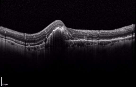 Figure 2d. Coupe verticale en OCT maculaire à 1 mois postvitrectomie. Disparition de l'hémorragie sous-rétinienne au niveau fovéolaire et visualisation de la cicatrice néovasculaire choroïdienne.
