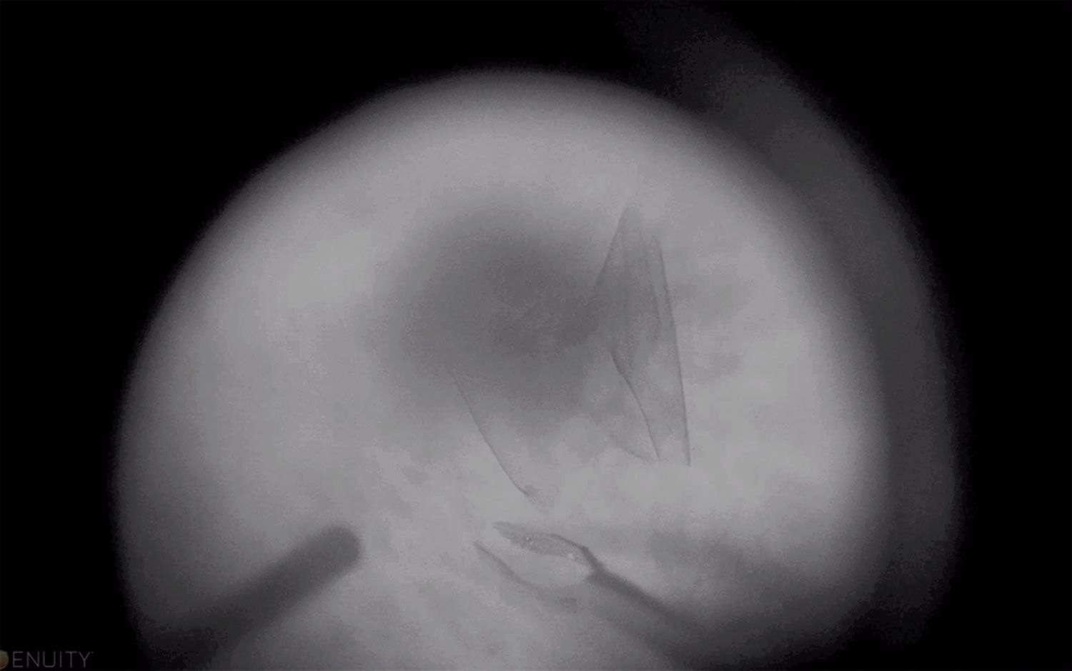 Figure 3. Image peropératoire d’une rétine d’un patient myope fort. Les contrastes sont optimisés par l’utilisation d’un filtre avec des niveaux de gris permettant la visualisation de la membrane limitante interne en cours de pelage.

