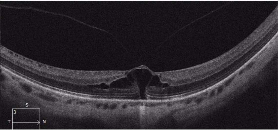 Figure 3. Coupe B-scan d’un fovéoschisis du myope. Présence de cavités kystiques intrarétiniennes qui ne correspondent pas à un OM.
