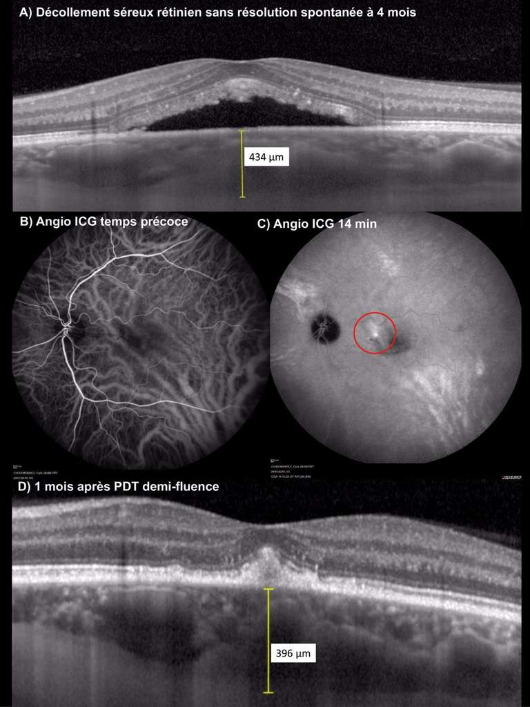 Figure 2. Homme de 42 ans présentant une récidive de CRSC au niveau de l’œil gauche sans résolution spontanée à 4 mois, responsable d’une baisse d’acuité visuelle à 4/10. A. OCT : décollement séreux rétinien rétrofovéolaire associé à une augmentation de l’épaisseur choroïdienne à 434 µm. B et C. Angiographie au vert d’indocyanine au temps précoce (B) : veines choroïdiennes dilatées (pachyvaisseaux) ; au temps intermédiaire (C) : plages hyperfluorescentes multifocales ; le spot de PDT est réalisé au niveau de la zone hyperfluorescente en supéronasal de la fovéa (rond rouge). D. OCT B-scan : 1 mois après la séance de PDT demi-fluence, résolution complète du décollement séreux rétinien associée à une diminution de l’épaisseur choroïdienne rétrofovéolaire à 396 µm.
