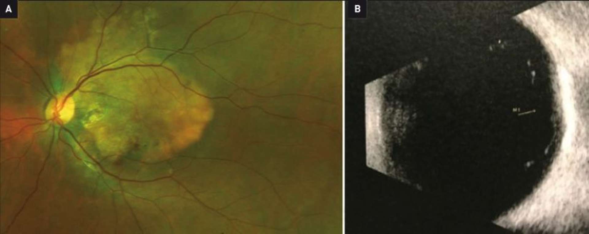Figure 1. Photographie du fond de l’œil montrant l’ostéome choroïdien au pôle postérieur, associé à des microhémorragies rétiniennes inférieures (A). Aspect de « pseudo nerf optique » de l’ostéome à l’échographie B (B).
