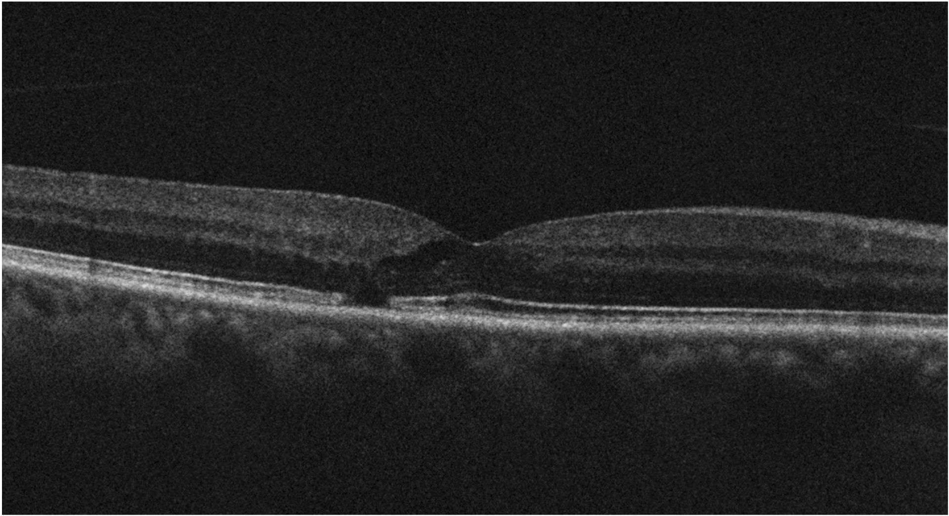 Figure 2. SD-OCT de l’œil droit d’un patient atteint de ­télengiec­tasies maculaires de type 2. On voit les cavités hyporéflectives associées à une interruption des couches externes de la rétine en temporal de la fovéa.
