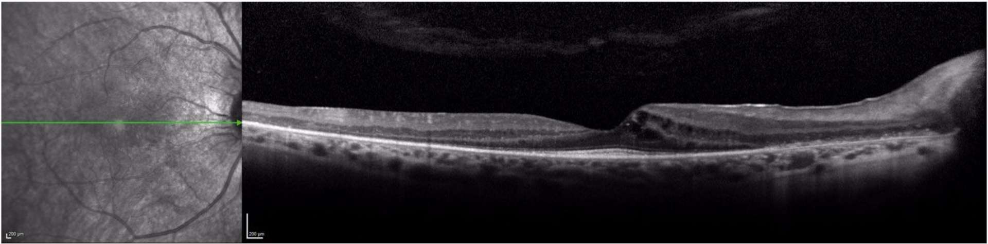 Figure 2. Coupe B-scan chez une patiente présentant une héméralopie. Sur le profil on retrouve quelques kystes intramaculaires associés à une atrophie de la rétine externe épargnant la macula, le tout conduisant au diagnostic final de rétinopathie paranéoplasique. 
