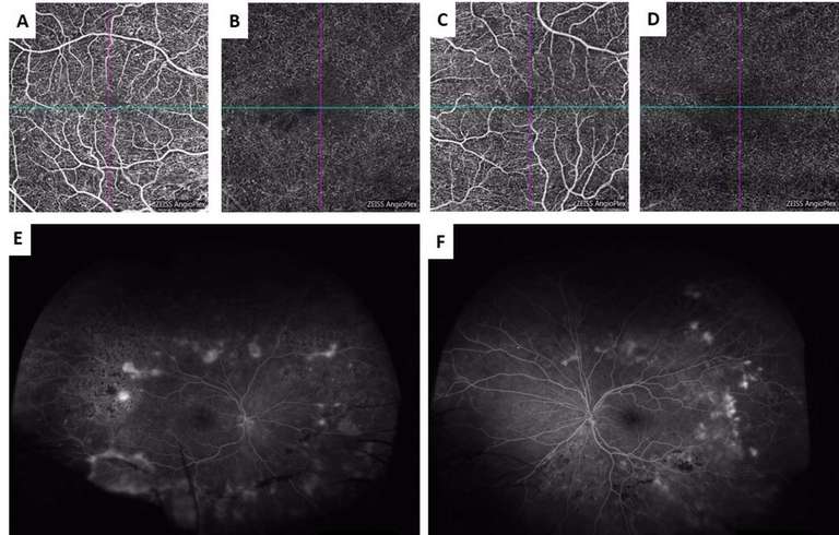 Figure 3. Rétinopathie diabétique proliférante bilatérale : OCT-A au niveau du plexus capillaire superficiel de l’œil droit (A) et de l’œil gauche (C) et du plexus capillaire profond de l’œil droit (B) et de l’œil gauche (D) ; AF grand champ de l’œil droit (E) et de l’œil gauche (F). L’angiographie montre des microanévrysmes, des néovaisseaux rétiniens, des zones de non-perfusion rétinienne avec des zones traitées par photocoagulation. L’OCT-A montre une désorganisation vasculaire minime avec quelques zones d’interruption de la ZAC mais ne met pas en évidence les lésions anévrysmales. (Dr Conrath, Centre Monticelli-Paradis).
