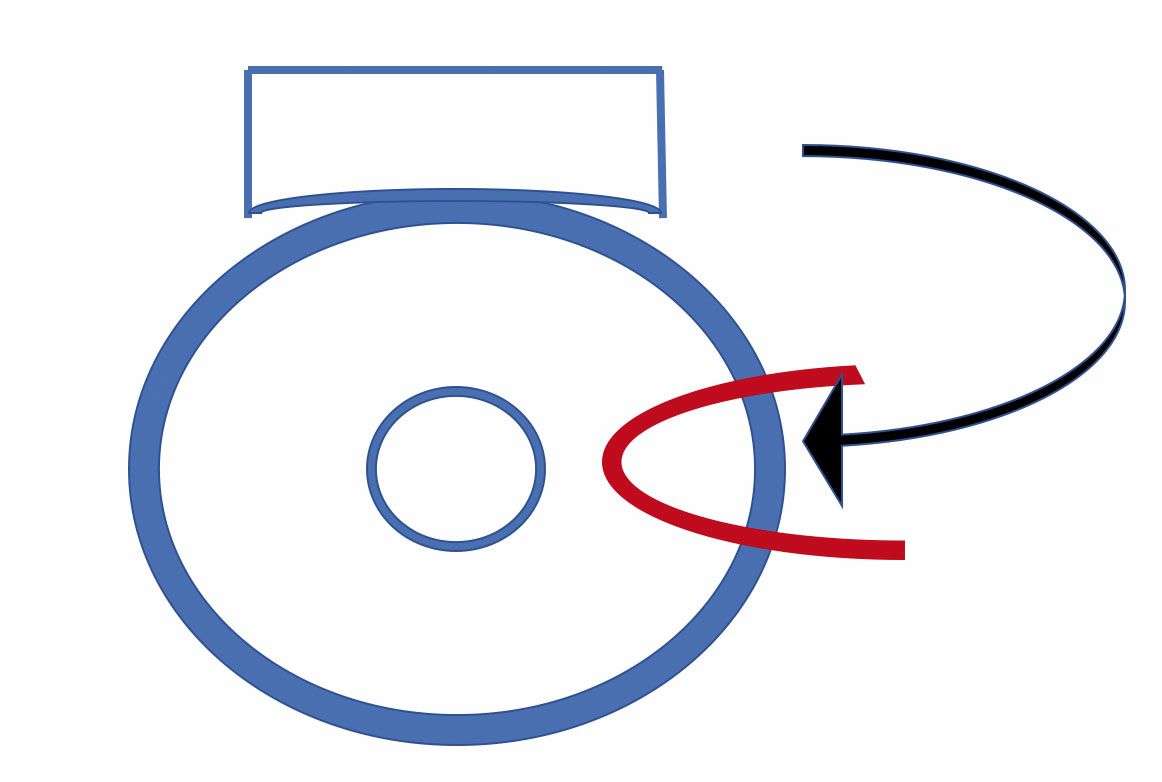 Figure 1. Technique chirurgicale d'ablation du ptérygion avec autogreffe de conjonctive.
