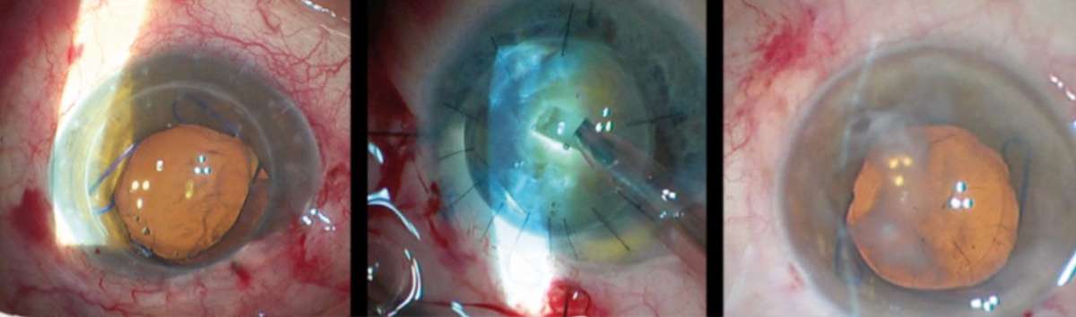 Figure 2. Utilité d’utiliser des gels de surface pour les anesthésies topiques pour les cas de visualisation difficile : cataractes sur greffes de cornées, petites pupilles ou opacités cornéennes par exemple.
