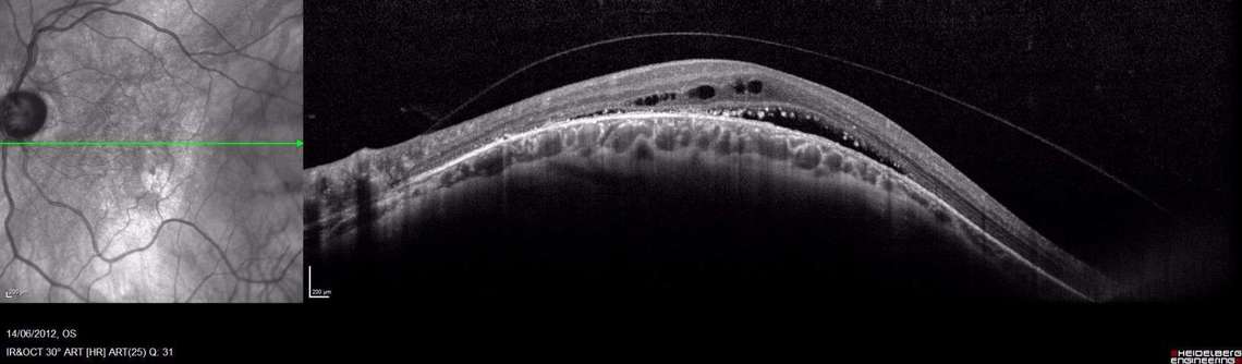 Figure 2. Coupe OCT chez un patient myope présentant une macula bombée. Noter la présence de liquide sous- et intrarétinien.
