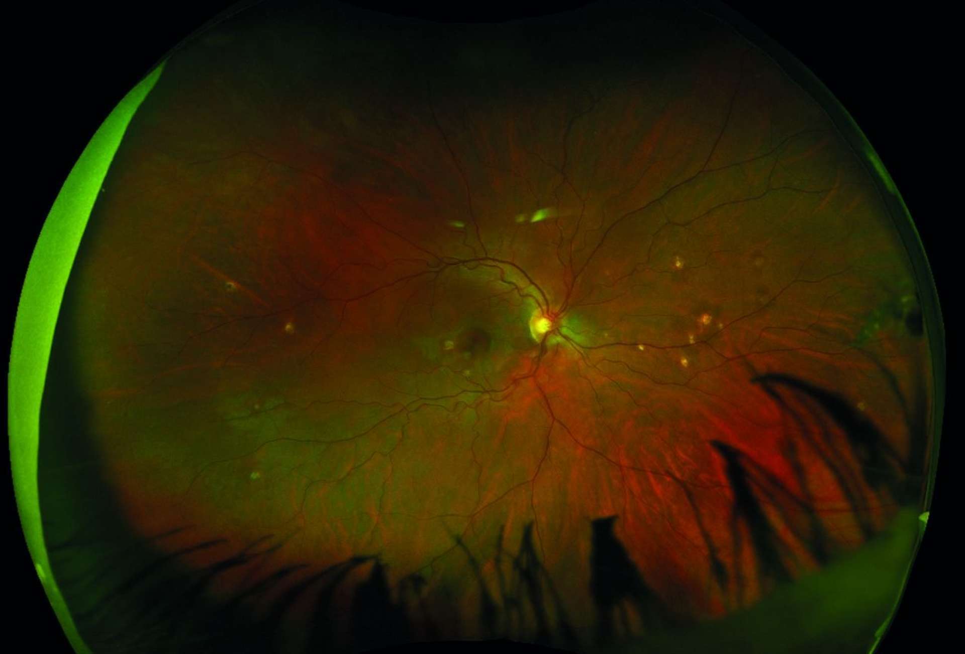 Figure 3. Photographie grand champ (Optos) du fond d’œil d’une patiente de 30 ans, montrant de multiples lésions choriorétiniennes jaunâtres en moyenne périphérie dans le cadre d’une choroïdite multifocale.
