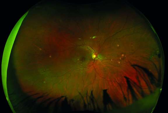 Figure 3. Photographie grand champ (Optos) du fond d’œil d’une patiente de 30 ans, montrant de multiples lésions choriorétiniennes jaunâtres en moyenne périphérie dans le cadre d’une choroïdite multifocale.

