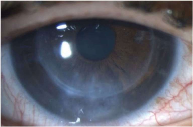 Figure 1A.&nbsp;Photographie de l’examen initial de l’œil gauche.
