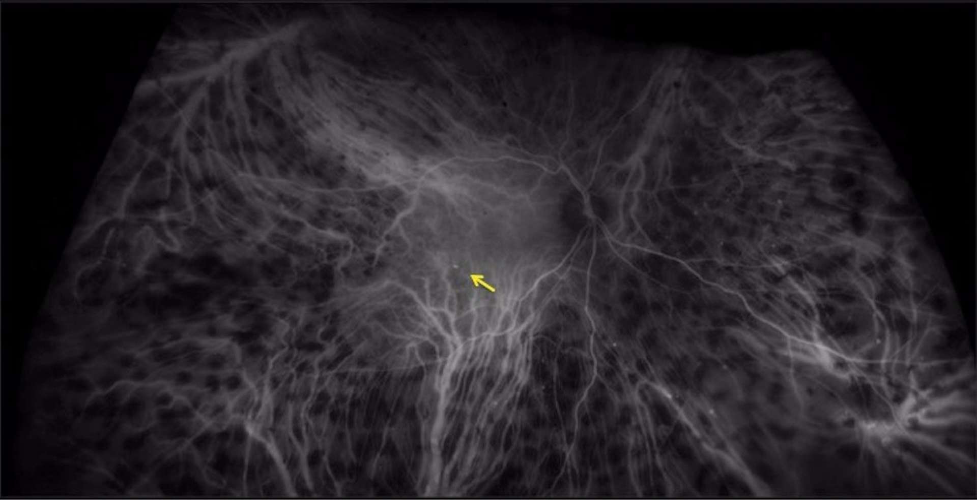 Figure 3. Angiographie au vert d’indocyanine (ICG) : bilan de résistance d’un OMD à un traitement bien conduit par IVT d’anti-VEGF. L’ICG confirme la présence d’un macroanévrysme capillaire qui entretient l’OMD (flèche jaune). De nombreux macroanévrysmes capillaires périphériques sont également visibles, sans conséquence sur la vision, ainsi que de multiples zones hypofluorescentes périphériques correspondant aux impacts d’une panphotocoagulation rétinienne.
