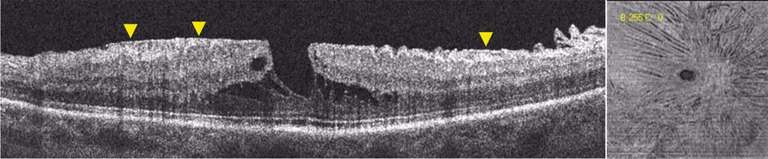 Figure 5. Coupe d’OCT B-scan et OCT En-face d’une membrane pré-maculaire avec fovéoschisis (« premacular membrane foveoschisis ») : la membrane est bien visible sous la forme d’une ligne hyper­réflective sur le B-scan (têtes de flèche jaunes) et les plis induits par celle-ci sont visibles sur l’En-face.
