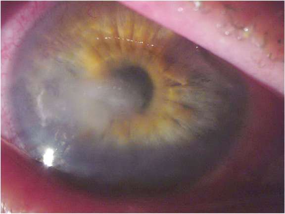 Kératite fongique secondaire à un mésusage de lentilles de contact journalières.
