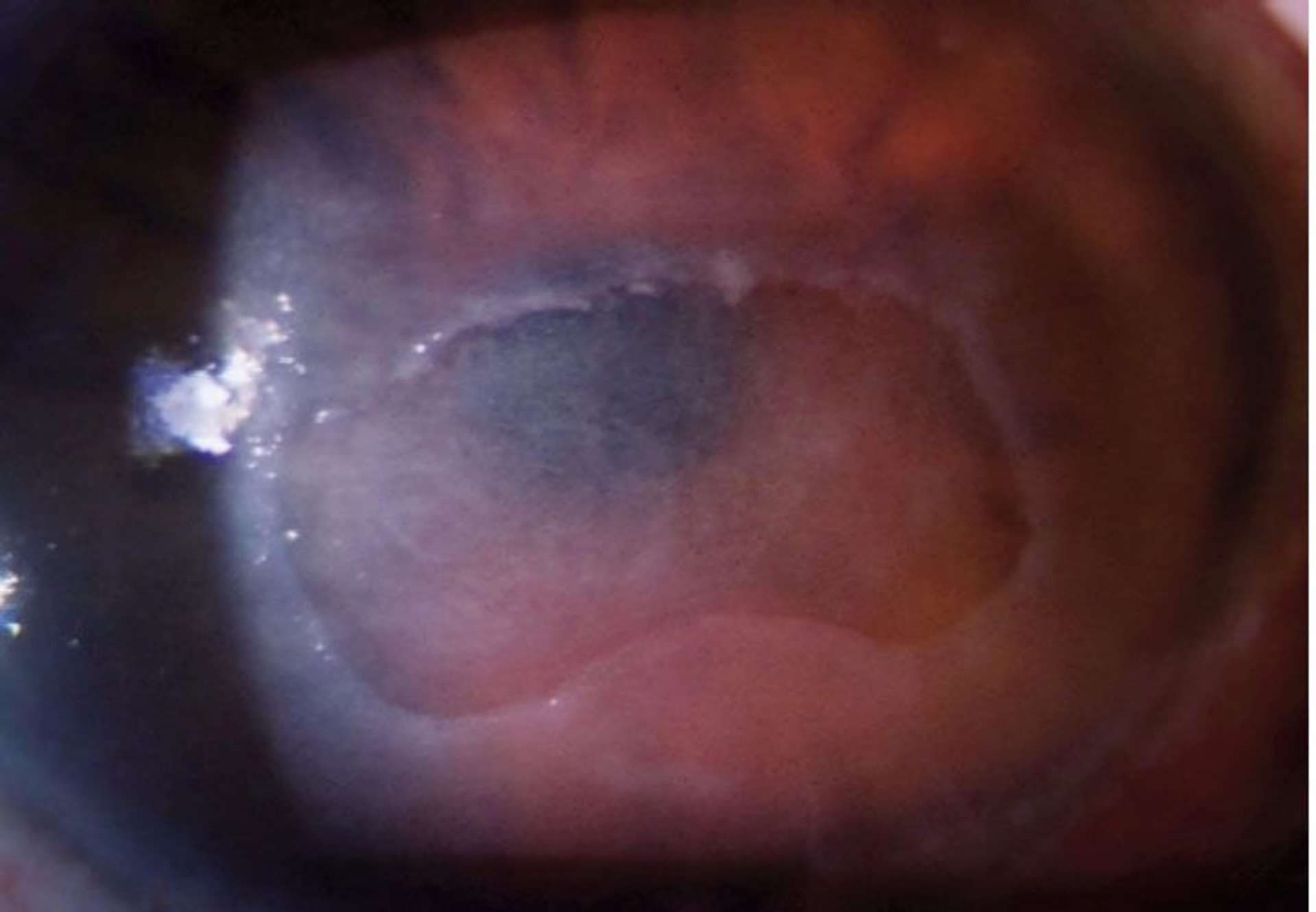 Photographie à la lampe à fente d’un ulcère cornéen d’origine neurotrophique, stade 2 selon la classification de Mackie. Anesthésie cornéenne totale

