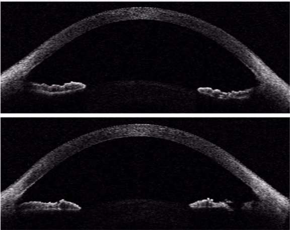 Figure 6. Glaucome pigmentaire : apposition de l’iris et de la face antérieure du cristallin et dépôts de pigments sur les fibres zonulaires. Vue gonioscopique avant l’iridotomie (haut), et coupes OCT avant (milieu) et après (bas) l’iridotomie.
