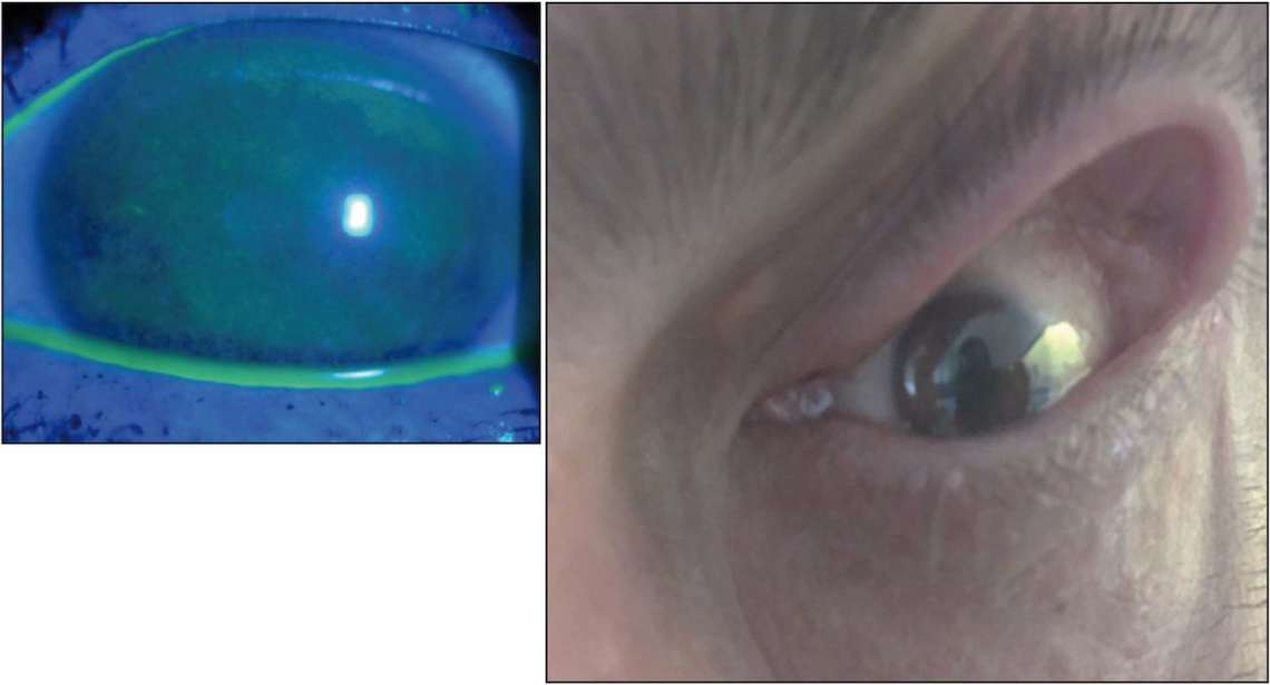 Figure 1. Kératite ponctuée superficielle diffuse chez un patient présentant un floppy eyelid syndrome associé à un syndrome d’apnée du sommeil.
