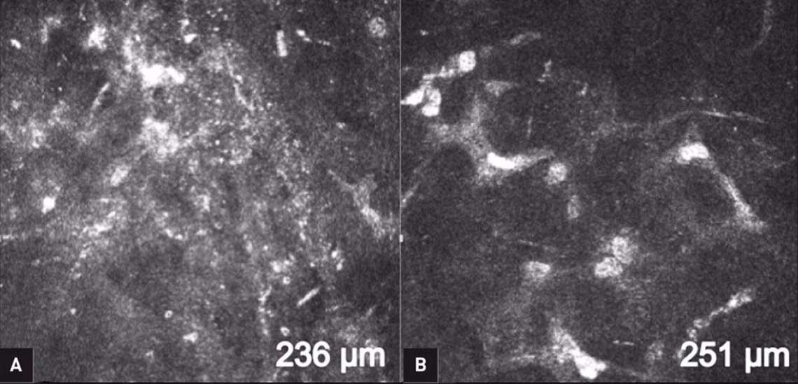 Figure 4. Stroma cornéen vu en microscopie confocale avant un CXL (A). Déficit kératocytaire et hyperréflectivité stromale vus en microscopie confocale 1 mois après un CXL conventionnel (B).
